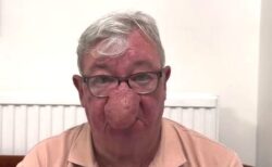 リアル・お茶の水博士！スコットランドの男性、鼻が異常に膨れてしまう