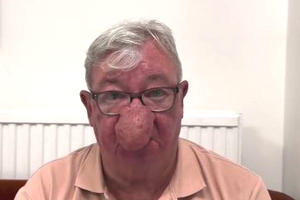 リアル・お茶の水博士!スコットランドの男性、鼻が異常に膨れてしまう