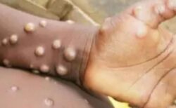 「エムポックス」の新たな変異株、イングランドで検出