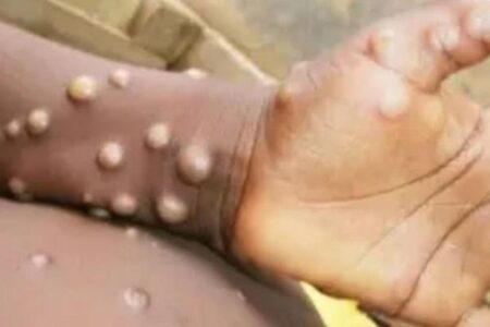 「エムポックス」の新たな変異株、イングランドで検出