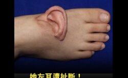 手術で左耳を足の甲に付けた女性が、動画を公開