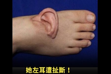 手術で左耳を足の甲に付けた女性が、動画を公開