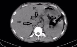 インドの男性患者、検査で3つの腎臓を持っていることが判明