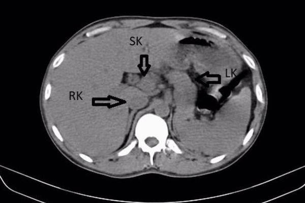 インドの男性患者、検査で3つの腎臓を持っていることが判明