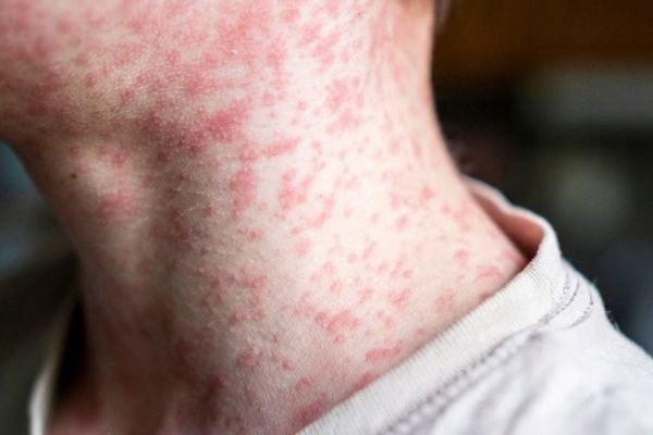 全米で麻疹の流行、過去30年間、稀だった病気が拡大した理由とは？