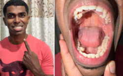 歯が普通より10本多いマレーシアの男性が、ギネス世界記録に