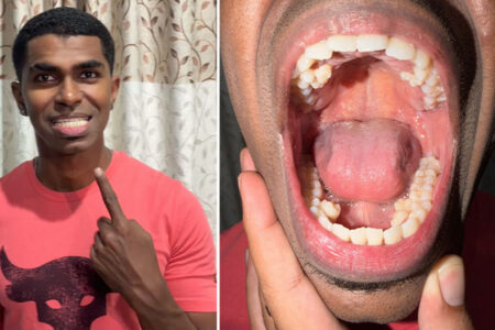 歯が普通より10本多いマレーシアの男性が、ギネス世界記録に