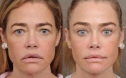 デニース・リチャーズ（55）、若返り手術の詳細を公開　4時間半の大手術