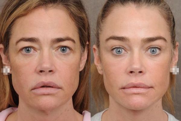 デニース・リチャーズ（55）、若返り手術の詳細を公開　4時間半の大手術