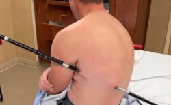 登山中、トレッキングポールが突き刺さった男性、自力で下山