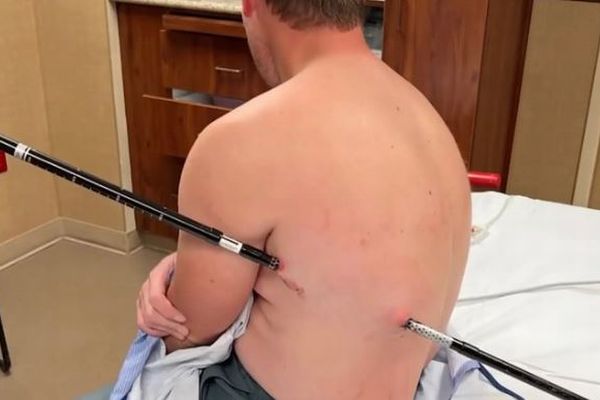 登山中、トレッキングポールが突き刺さった男性、自力で下山