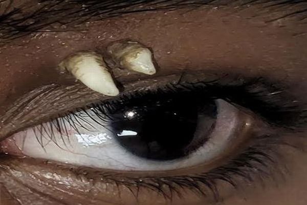 インドの少年、目の上から歯が生える、極めて珍しい症例を報告